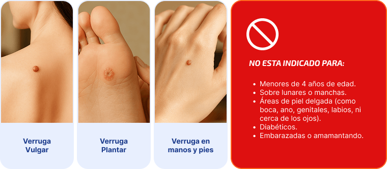 para-ti-verrugas